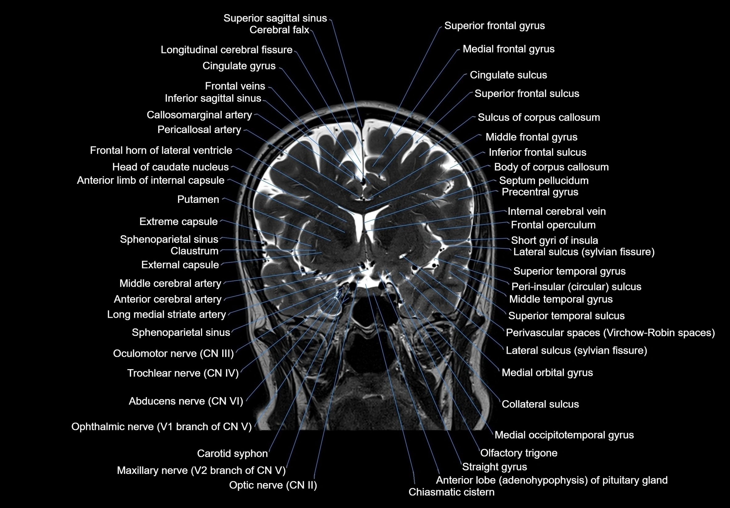 MRI Brain coronal cross sectional labelled anatomy 3T image  -img-00001-00030.webp